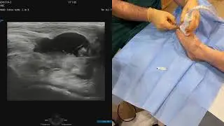 Traitement du Névrome de Morton par Écho-Chirurgie : Une Technique Innovante