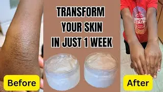 DIY Healing Body Butter: Clear Skin-Clearing Body Butter at Home!
