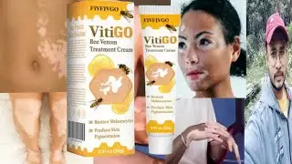 Vitigo Bee Venom Treatment Cream | Honest Review
