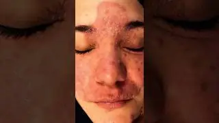 Facial Tinea | Homeopathy #shorts #viral #homeopathy