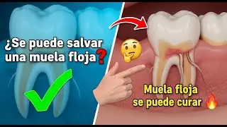 ✅ ¿Se puede salvar una muela floja? / Muela floja se puede curar 👈😳