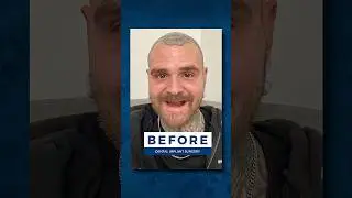 No One Warned Me About The Hidden Costs Of My Dentures