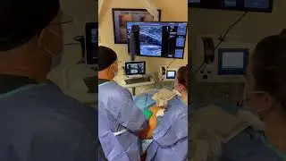 Vein Treatment using tumescent numbing solution around the saphenous vein