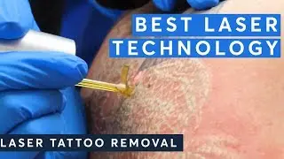 Best Laser Technology - Laser Tattoo Removal