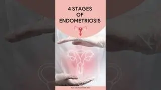 4 Stages of Endometriosis: Symptoms