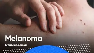 C&oacute;mo identificar y prevenir los melanomas &ndash; En Casa Salud