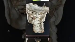 3D spinal imaging of neck 👀 #advancedimaging #3dimaging #bonespurs #uppercervicalchiropractic