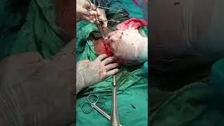 Dr.A.S.M.Sayem operation for Nupur