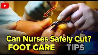 Can Nurses Safely Cut Diabetic Toenails? Important Foot Care Tips