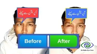 Squint (Bhengapan) Eye 25-Degree Correction Surgery Detail | Urdu/Hindi