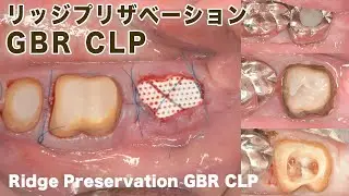 リッジプリザベーションGBR【CLP】Ridge Preservation GBR CLP