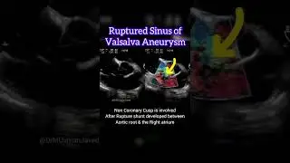Ruptured Sinus of Valsalva Aneurysm #echocardiography #echocardiogram #cardiology #lcx
