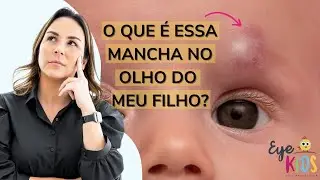 HEMANGIOMA CAPILAR | O QUE É ESSA MANCHA VERMELHA NO OLHO DO MEU FILHO? É GRAVE?