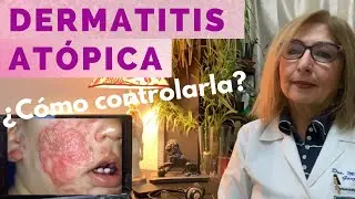 DERMATITIS ATÓPICA ¿CÓMO CONTROLARLA?