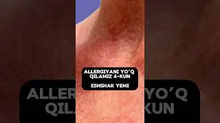Teridagi toshma yoki eshshak yemi #tabiiydavolash #allergiya #tibbiymaslahat #soglomhayot #аллергия