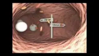 Embolização de Miomas - Centro de Mioma