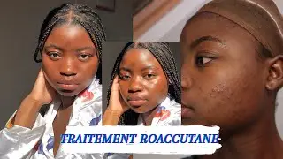 BILAN 1 AN APRÈS TRAITEMENT ROACCUTANE/CURACNÉ/ACCUTANE TREATMENT PEAU NOIRE/DARK SKIN