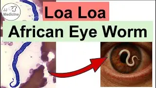 Loa Loa (Worm Moving In The Eye) | Flies, Pathophysiology, Symptoms, Diagnosis, Treatment