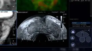 Transrectal MR/US fusion biopsy of an anterior prostate cancer