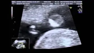 Anuncio Bebe en Camino