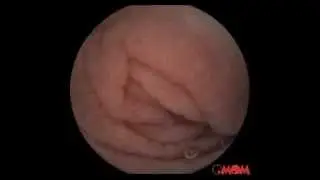 Видеокапсульная эндоскопия OMOM