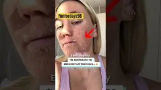 Will I regret this $1800 treatment🫩 #skintreatment #skincare #shortsfeed #shortshorts #burn #shorts