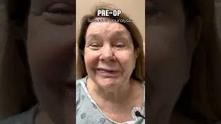 Smile transformation after Selective Neurolysis surgery #plasticsurgery #facialparalysis #bellspalsy