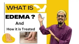 What is Edema ? | Edema Causes | Edema Types | Edema Treatment