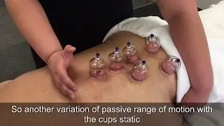 Cupping Demo For Lower Back Muscular Discomfort