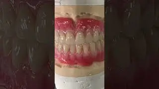 Wax Try-In Set-Up