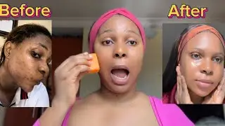 I Tried Kojie San for Dark Spots - Does It Work?