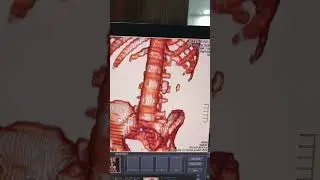 CT Scan KUB 3D | Kidneys, Ureters & Bladder Ful Explanation | Procedure, Purpose & 3D Imaging Detail