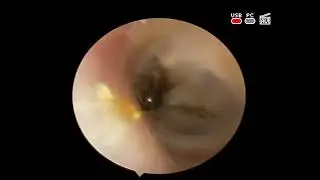 #foreign body #mosquito into external auditory canal #ent #kyiv #ukraine