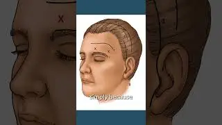 Temporal Lift vs Brow Lift Surgery | #shorts
