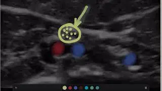 Patient - How to hold probe lift compression.mp4