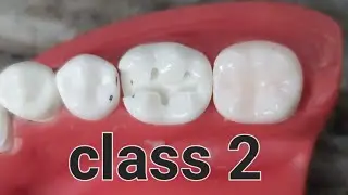 class 2 cavity preparation for lower 6 ⁉️شرح مهم جدا ⁉️