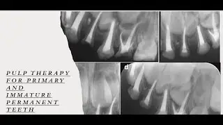 Pulp Therapy for Primary and Immature Primary Teeth