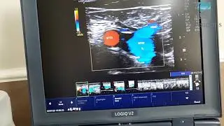 Duplex Scan Venoso &eacute; fundamental no diagn&oacute;stico da Trombose Venosa Profunda