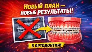 План лечения ортодонтии — КОГДА и ПОЧЕМУ его меняют❓️