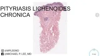 Pityriasis Lichenoides Chronica. Dermpath Made Easy.