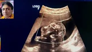 Anomaly Scan 20 weeks Pregnancy tricks and tips Level 2 scan