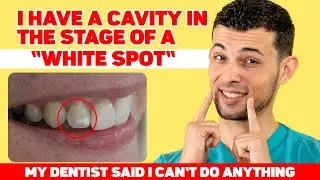 I have a cavity in the stage of a 