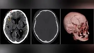 شرح المحاضره التالته من دوره الاشعه المقطعيه علي المخ CT Brain 🧠