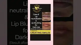 Lip blushing for dark/black/pigmented/vitiligo lips! Painless way to get pink Lips by Dr.Ankita