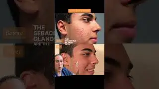 Accure Laser Treatment For Acne   Before & After