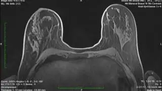 Breast Mri Fat Sat Pre con