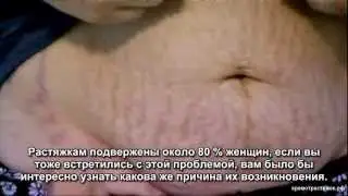 Подростковые проблемы с кожей: растяжки