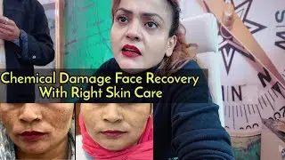 Chemical Damage |how to treat pigmentation at home | pigmentation solution ||khailyat &ndash; Nisha Lambha
