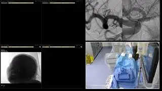 Case-6, MCA Aneurysm, 01-02-2026