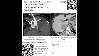 Case 150:   Right Adrenal Gland Nodule Biopsy Prone Perivertebral Mediolateral Approach